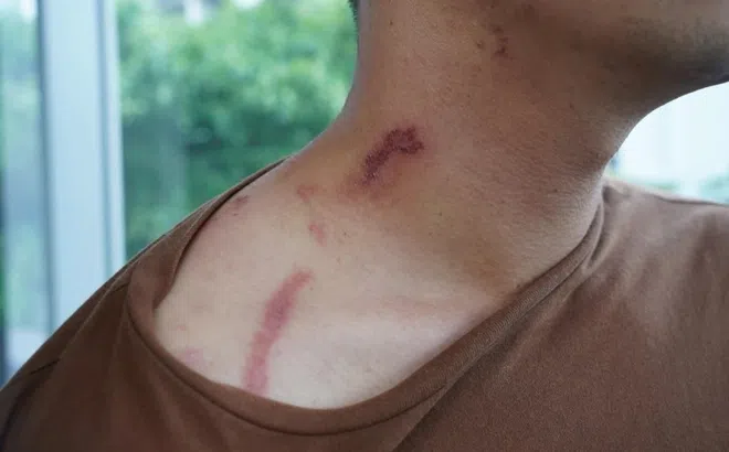 Dấu hiệu trên da chứng tỏ bị kiến ba khoang đốt