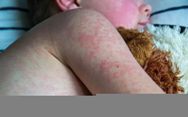 Bệnh sởi và những điều cần biết