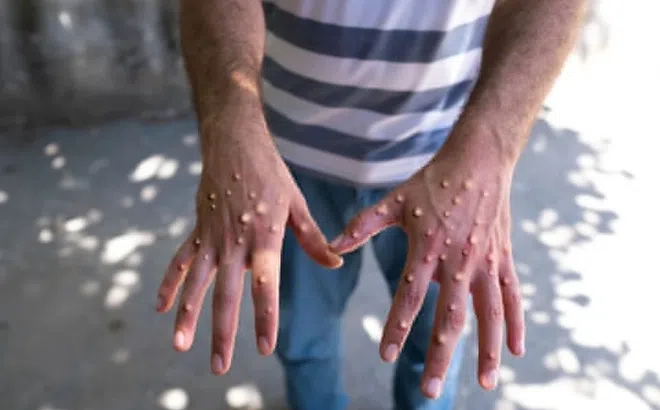 4 biện pháp phòng bệnh đậu mùa khỉ