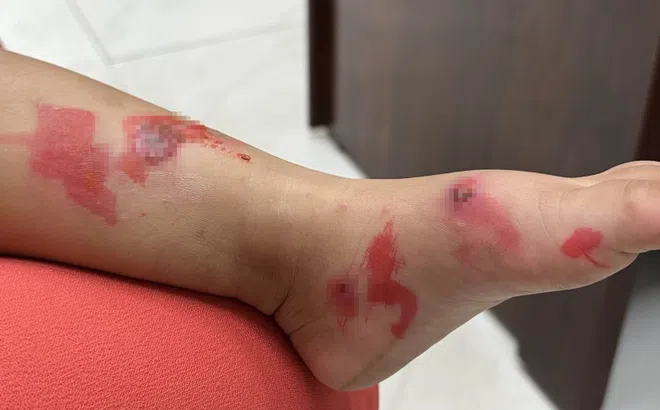 Các bệnh nhiễm trùng da phổ biến