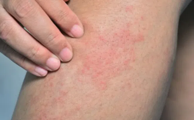 Thực phẩm phổ biến gây dị ứng