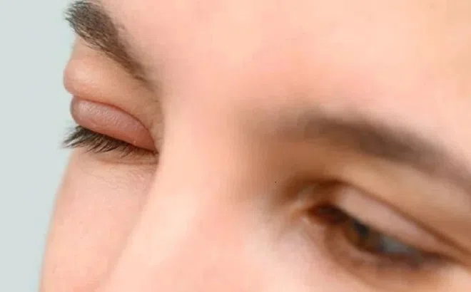 Làm gì khi mắt bị lẹo?