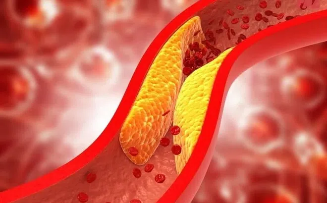 Những ai dễ bị xơ vữa động mạch?