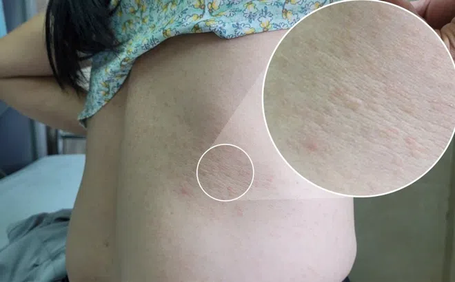 Ngứa ngáy suốt 2 năm, người phụ nữ bất ngờ khi biết lý do