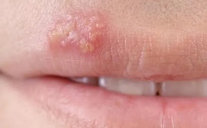 Cách phòng tránh lây nhiễm Herpes sinh dục