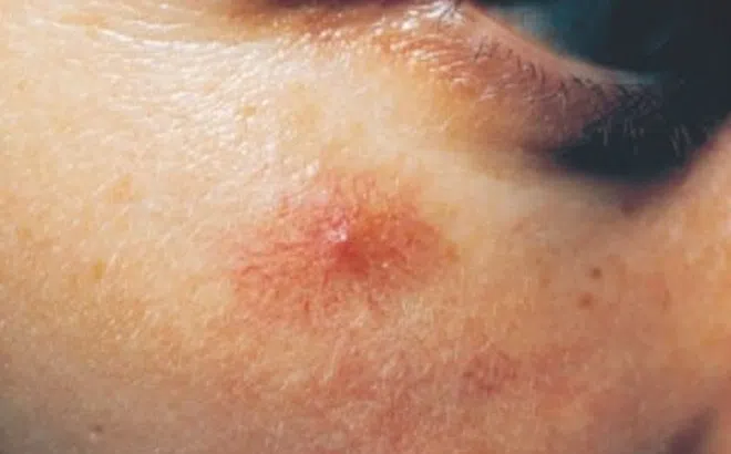 3 dấu hiệu bệnh gan biểu hiện ngay trên mặt