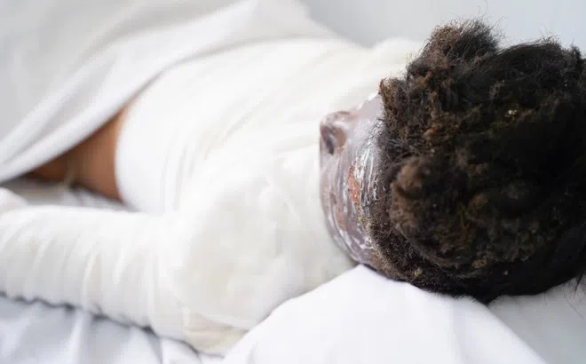 Hàng loạt ca nhập viện ở TP.HCM vì pháo nổ