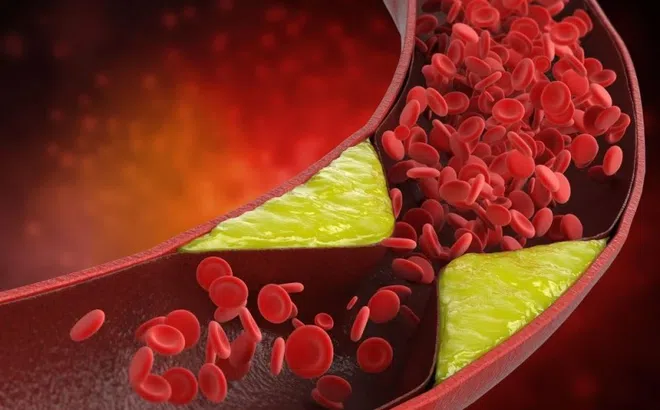 Những người dễ bị mỡ máu nhất