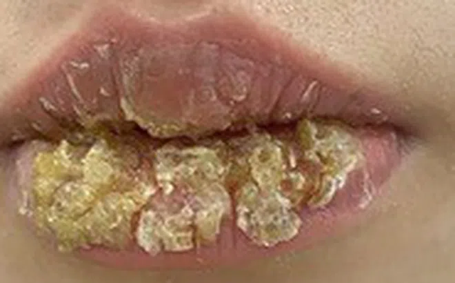 Môi biến dạng, chảy dịch sau khi xăm môi thẩm mỹ, cảnh giác biến chứng xăm môi