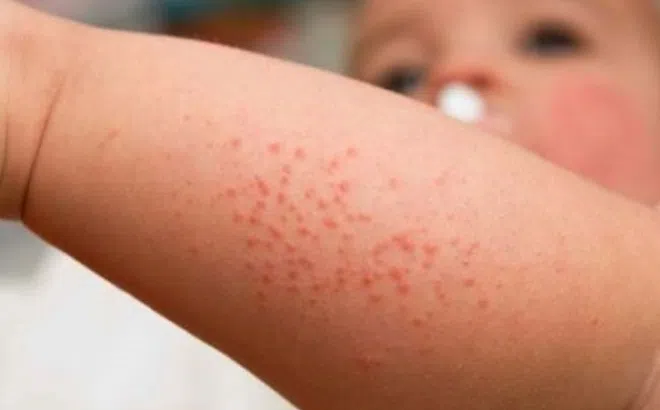Bé gái nguy kịch do biến chứng sởi, cha mẹ cần cảnh giác biểu hiện sau