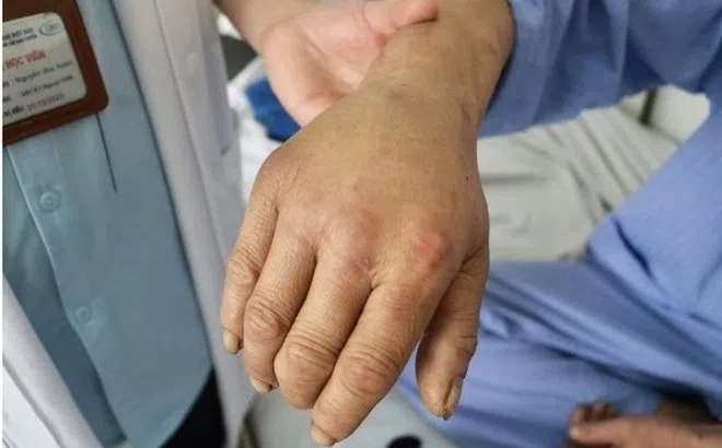 Tin lời 'thần y', người đàn ông nhập viện trong đau đớn