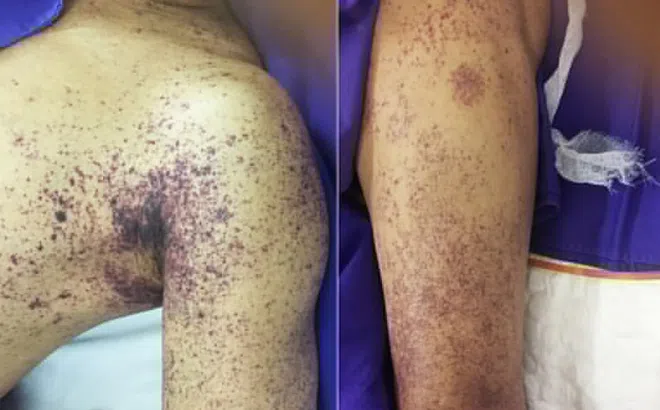 Gánh hậu quả vì thường xuyên ăn tiết canh, đồ tái sống