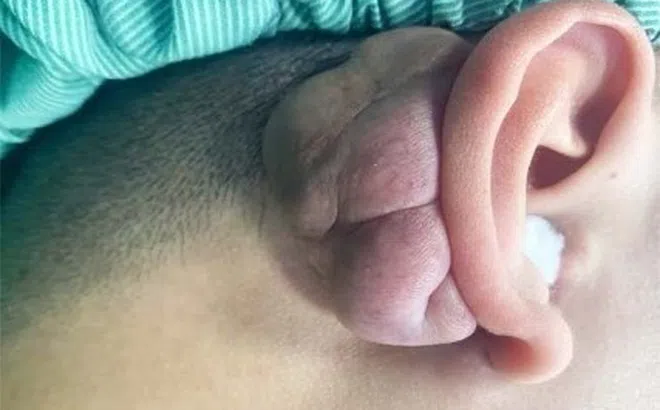 Giải cứu vành tai cho nam thanh niên 22 tuổi mắc ung thư