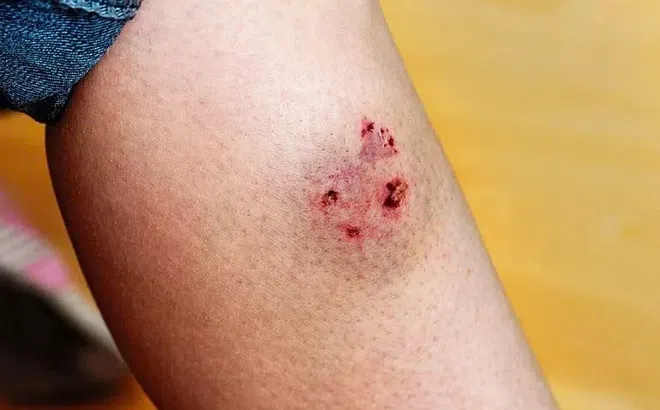 Sau 2 tháng bị chó cắn, người đàn ông mất mạng