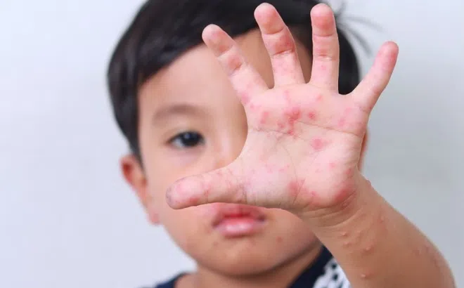 Biến chứng nguy hiểm khi trẻ bị tay chân miệng