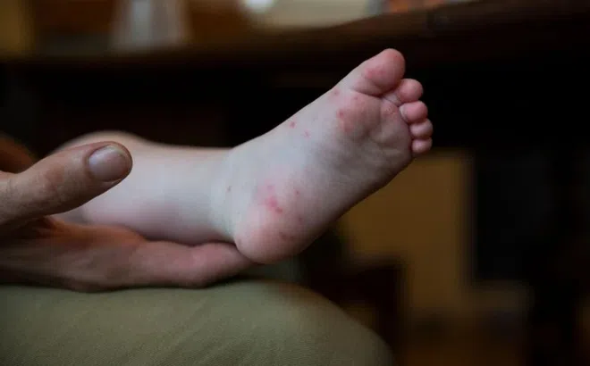 Vì sao trẻ mắc tay chân miệng rồi vẫn có thể bị lại?