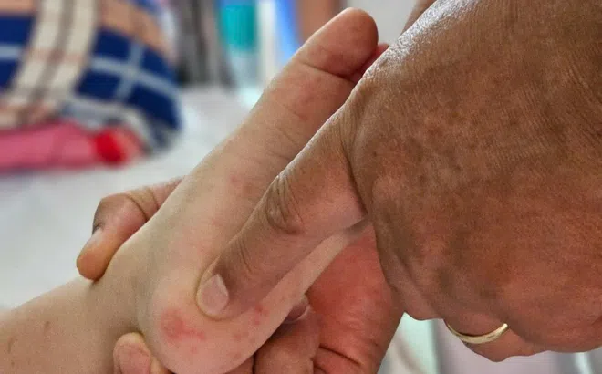 Số ca bệnh tay chân miệng ở TP.HCM tiếp tục tăng