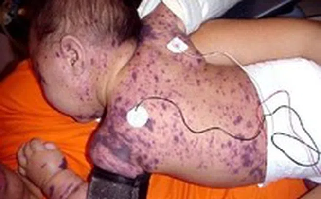 Bệnh não mô cầu dễ lây lan, nguy cơ xuất hiện thêm ca cộng đồng, phòng bệnh thế nào?
