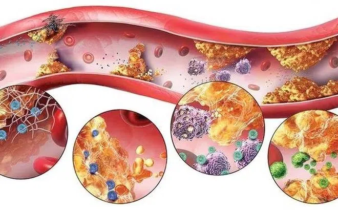 7 triệu chứng cảnh báo bạn mắc rối loạn mỡ máu