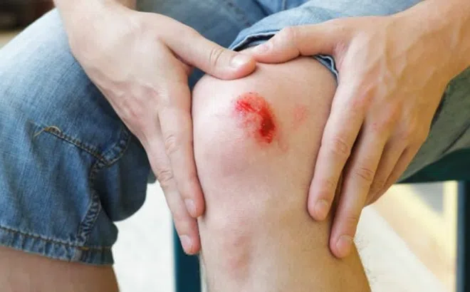 6 bước chăm sóc vết thương hở mau lành