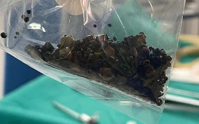 Hàng trăm viên sỏi trong túi mật người phụ nữ