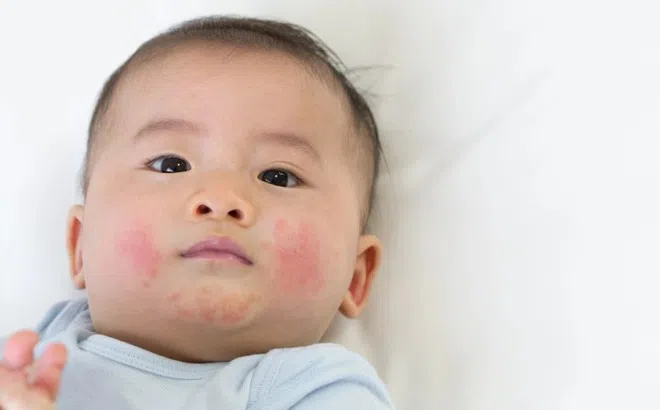 Dấu hiệu cảnh báo trẻ bị viêm da cơ địa