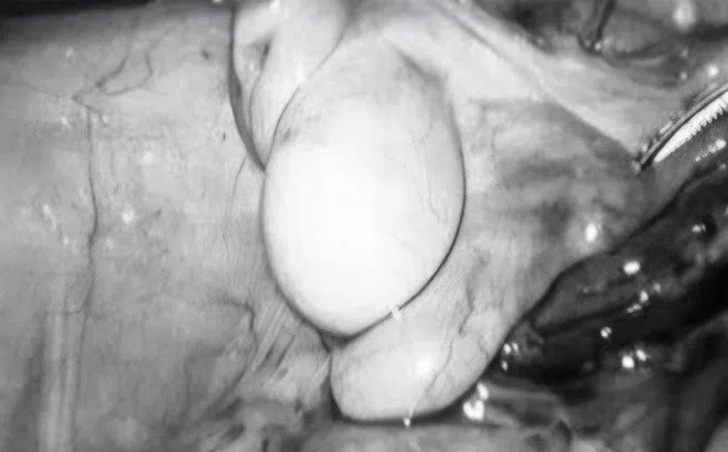Bé trai 11 tuổi thoát nguy cơ vô sinh nhờ ca mổ nội soi hạ tinh hoàn