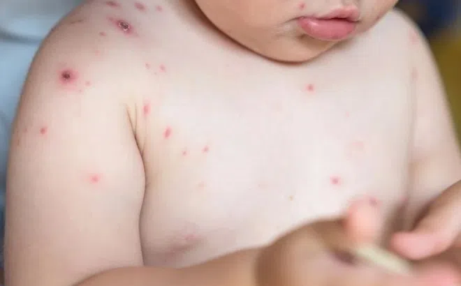 Căn bệnh quen thuộc có thể cướp sinh mạng trẻ sơ sinh trong vài ngày