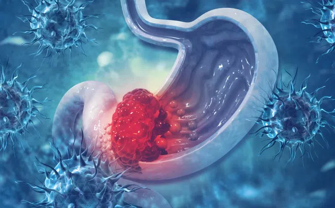 5 thực phẩm có thể giúp ngăn ngừa ung thư dạ dày