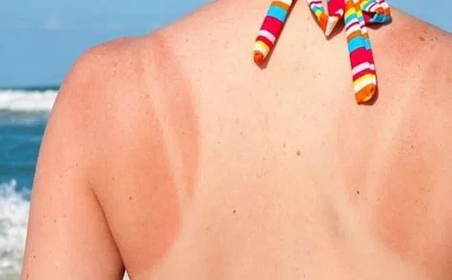 Cách phục hồi làn da sau rám nắng mùa hè