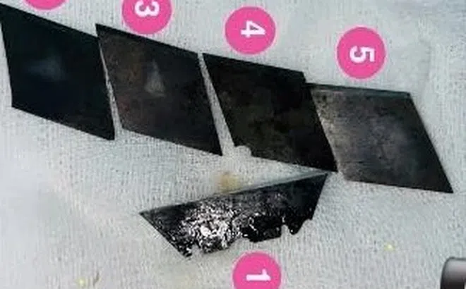 Gắp 5 lưỡi dao ra khỏi cơ thể nam thanh niên 26 tuổi