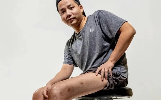 Khoa Pug chi 3 tỷ kéo chân lần 2: Bác sĩ nói gì?