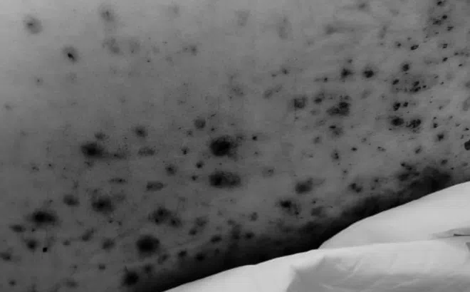 Thanh niên 30 tuổi nguy kịch vì thủy đậu, bệnh tưởng chỉ gặp ở trẻ