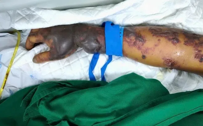 Một bệnh nguy hiểm từ lợn đang gia tăng, Bộ Y tế phát cảnh báo