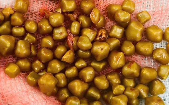 Mổ cấp cứu nữ bệnh nhân có hơn 100 viên sỏi chứa đầy trong túi mật