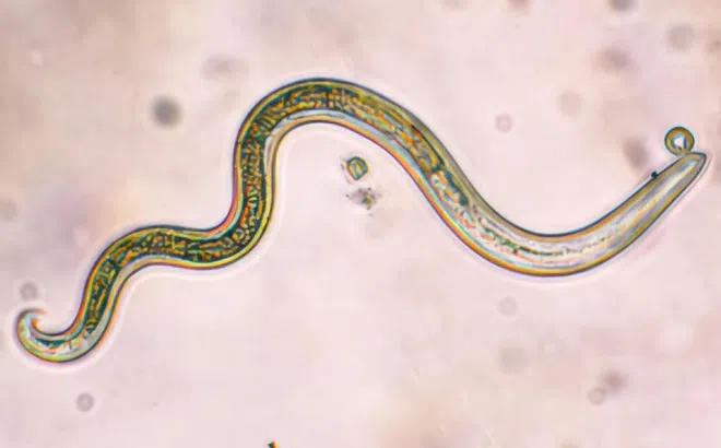 Nữ bệnh nhân nhiễm loại giun nguy hiểm nhưng không biết