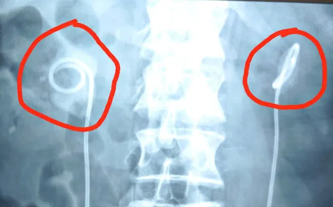 Quên rút ống thông niệu quản suốt 2 năm, người đàn ông biến chứng nặng nề