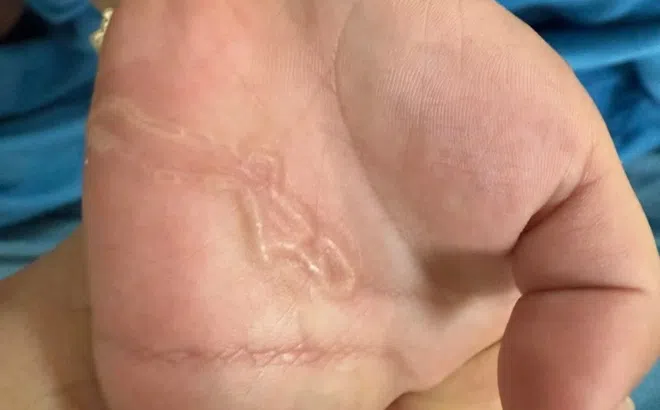 Sán ký sinh, nổi ngoằn ngoèo dưới da bé trai