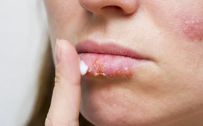 Dùng thuốc nào để điều trị chốc lở