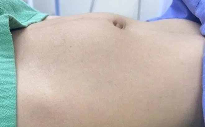 Bé gái 15 tuổi bất ngờ mắc loại ung thư sinh dục hiếm gặp