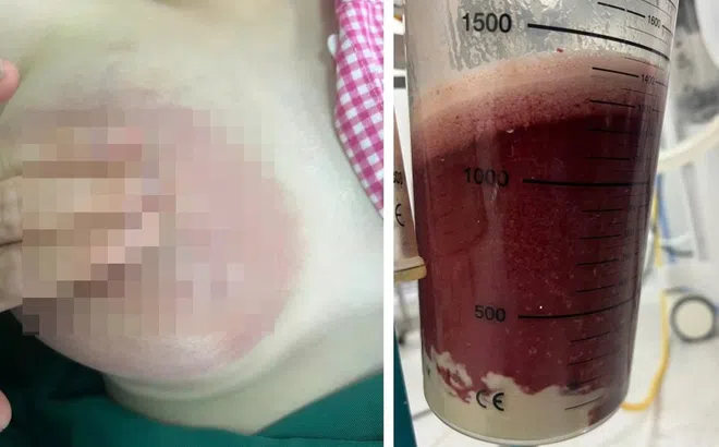 Mẹ trẻ bị áp xe ngực vì một sơ suất khi cho con bú