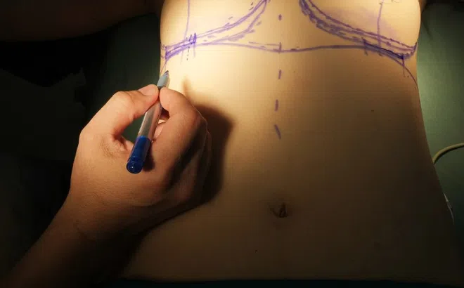 Phương pháp nâng ngực được ưa chuộng nhất