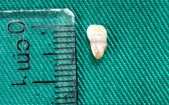 Trẻ sơ sinh có răng mọc ngay lúc sinh, hiện tượng hiếm gặp hay kỳ lạ?