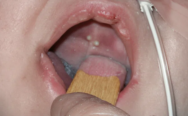 Con bạn có nanh sữa khi vừa sinh, có cần điều trị sớm?