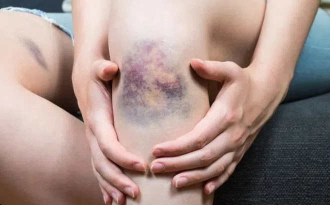 Dấu hiệu cơ thể cảnh báo nóng gan