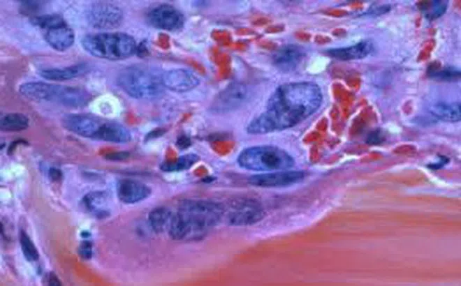 Làm rõ tin đồn 'khối u là túi độc tố và sinh thiết khiến độc tố phát tán'