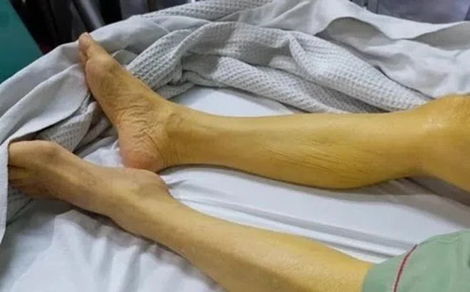 Vì sao người Việt dễ mắc ung thư gan?