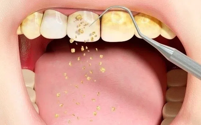 Điều gì xảy ra khi không lấy vôi răng?