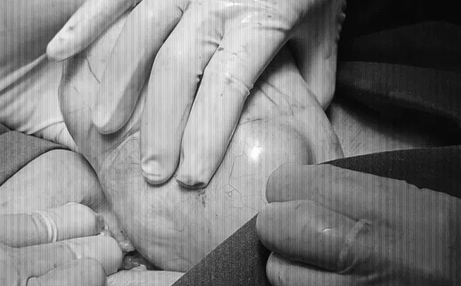 Cắt bỏ khối u nang buồng trứng nặng gần 2kg