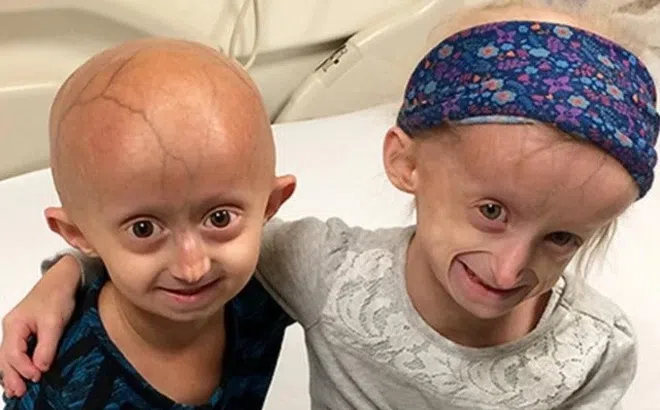 Bí ẩn gene lỗi khiến trẻ nhỏ già đi như người già